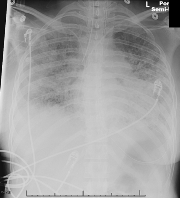 A 36-year-old woman comes to the emergency department because of worsening shortness of breath and cough for 4 days.  Her medical problems include rheumatoid arthritis, interstitial lung disease on home oxygen, and pulmonary hypertension.  Her trachea is cannulated because of respiratory distress and central venous access is obtained. In the intensive care unit, her temperature is 37.2 C (99 F) , blood pressure is 99/67 mm Hg, and pulse is 120 /min.  The patient's pulse oximetry shows 100% on assist control mode with tidal volumes of 300 mL, respiratory rate of 20/min, fraction of inspired oxygen (FiO<sub>2</sub>)  of 100%, and positive end-expiratory pressure (PEEP)  of 5 cm H<sub>2</sub>O.  Examination reveals right-sided crackles and decreased breath sounds on the left.  Heart sounds are regular with a loud second heart sound.  The abdomen is soft and non-tender.  Examination shows no peripheral edema. Laboratory values are as follows:   A chest radiograph is performed.   Which of the following is the most appropriate next step in management? A) Increase PEEP B) Increase tidal volume C) Insert a chest tube D) Reposition the endotracheal tube E) Suction respiratory secretions