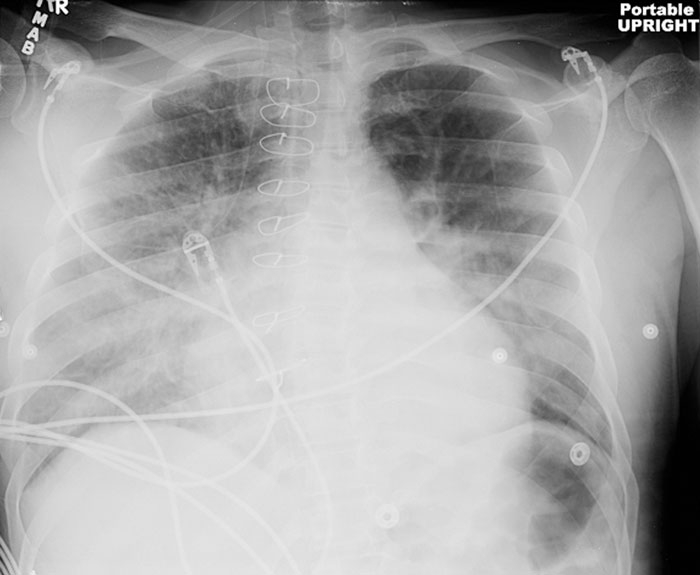 A 47-year-old man is hospitalized due to worsening shortness of breath over the last 2 days.  He complains of orthopnea requiring 2 pillows to sleep.  The patient has a history of coronary artery disease and underwent coronary artery bypass grafting 2 years ago.  He has been nonadherent with his medications. His temperature is 98.6° F (37° C) , blood pressure is 157/90 mm Hg, pulse is 113/min, and respirations are 34/min.  Pulse oximetry shows 88% on 100% O<sub>2</sub> non-rebreather face mask.  He appears to be in respiratory distress and is using accessory muscles of respiration.  Jugular venous pressure is estimated at 12 cm H<sub>2</sub>O.  Examination shows a third heart sound and bibasilar crackles.  There is 1+ pitting peripheral edema bilaterally to the shins. The patient's chest-x ray is shown below.   ECG shows sinus tachycardia with nonspecific T-wave changes. Which of the following best describes how noninvasive positive pressure would benefit this patient? A) Decrease in functional residual capacity B) Decrease in minute ventilation C) Decrease in preload D) Increase in afterload E) Increase in dead space ventilation