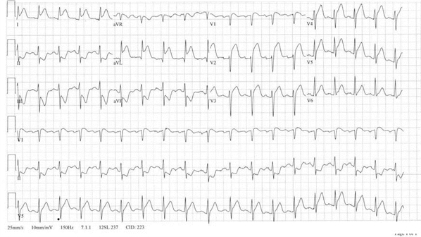 <strong>A 56-year-old woman who is post-operative day #1 after a laparoscopic cholecystectomy complains of chest discomfort. The patient reports that in the early hours of the morning, she was awakened from sleep with nausea, one episode of vomiting, and persistent burning in her chest. Her only medical history includes hypertension, which has been well-controlled with medication. Her other current medications include ondansetron, acetaminophen, and hydrocodone. Her temperature is 37.9 C (100.2 F), blood pressure is 92/60 mm Hg, heart rate is 90 /min, and respirations are 18 /min. Her BMI is 31 kg/m<sup>2</sup>. She is in moderate distress and appears anxious. There is no murmur on cardiac examination and bilateral fine crackles are heard at the lung bases. Her abdomen is distended and non-tender with an incision that is clean and intact. Bowel sounds are diminished. There is no rebound tenderness or rigidity. There is no peripheral edema. A 12 lead EKG is performed and displayed below: Which of the following would be the most appropriate next step in managing this patient?</strong> A)Coronary angiography B)CT scan of the chest with contrast C)Intravenous metoprolol D)Pantoprazole and morphine E)Transthoracic echocardiogram