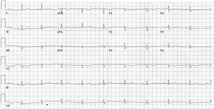 <strong>A 67-year-old woman comes to the physician because of edema and shortness of breath. She reports that the edema has been present for approximately 3-4 months and involves her lower extremities. The shortness of breath occurs with minimal exertion and occasionally at rest. She denies chest pain or pressure, cough, and fever. She has history of breast cancer diagnosed 12 years ago that was treated with mastectomy, chemotherapy, and chest wall radiation therapy. Her medications include aspirin, fish oil, and simvastatin. Her blood pressure is 115/70 mm Hg, pulse is 62/min, and BMI is 27 kg/m<sup>2</sup>. The patient is in no acute distress. Her lungs are clear bilaterally. There is a normal S1 and S2 with a 2/6 apical murmur that radiates to the axilla. She has 3+ pitting edema below the knees bilaterally. Her electrocardiogram is shown below. A transthoracic echocardiogram shows a normal left ventricular cavity size, a left ventricular ejection fraction of 70%, biatrial dilatation, severe left ventricular hypertrophy, and moderate mitral regurgitation. Which of the following is the most likely additional finding in this patient?</strong> A)Ascending aortic aneurysm B)Carotid artery occlusion C)Cavitary lung lesions D)Hyperthyroidism E)Significant proteinuria