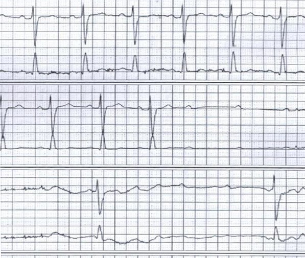 A 77-year-old woman comes to the physician because she  passed out.   She says that over the last few months she has had several episodes where she feels very lightheaded and must sit down.  On one occasion, she did actually lose consciousness and hit her head against a bathroom counter.  There are no clear precipitants of these episodes.  She denies chest pain or pressure.  She thinks that she is more short of breath while playing tennis than she used to be in the past.  Her other medical problems include hypertension and mild chronic kidney disease.  Her medications include amlodipine, lisinopril, simvastatin, and aspirin. Her blood pressure is 115/70 mm Hg, pulse is 62/min, and BMI is 23 kg/m<sup>2</sup>.  The patient is in no acute distress.  There is a normal S1 and a soft S2.  There is a III/VI mid-peaking systolic ejection murmur at the right upper sternal border that radiates to both carotid arteries.  Her lungs are clear to auscultation.  Her abdomen is soft and non-distended.  Peripheral pulses are 2+ and symmetric. An echocardiogram showed normal left ventricular function, mild left ventricular hypertrophy, and moderate calcific aortic stenosis with an estimated aortic valve area of 1.4 cm<sup>2 </sup>(normal 3-4 cm<sup>2</sup>) . The patient was given a 24-hour Holter monitor.  The tracing below was recorded at 1:25 pm.   Which of the following would be the best next step in managing this patient? A) Aortic valve replacement B) Discontinuation of amlodipine with close follow-up C) Exercise stress testing D) Permanent pacemaker placement E) Tilt table testing