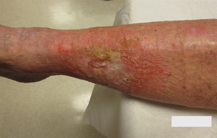 An 82-year-old woman is brought to the clinic by her caregiver for a new leg wound.  The patient has had chronic lower-extremity swelling for many years.  Over the past 2 weeks, she developed a small, shallow opening on her right anterior lower leg that has slowly expanded.  She has no fever, chills, warmth, or purulent drainage.  The patient says that her legs often feel tired and heavy, especially when sitting for extended periods, but they improve with walking. Her past medical history includes hypertension, degenerative joint disease, and obesity. Vital sign signs normal.  Cardiovascular examination shows normal rate and rhythm and no murmurs.  Estimated jugular venous pressure is normal.  The patient's lungs are clear.  Lower extremities have symmetric edema bilaterally; the wound is shown in the image below.  The feet are warm with palpable dorsalis pedis pulses bilaterally.   In addition to wound dressing recommendations, what is the best next step in management of this patient? A) Ankle brachial index B) Compression garments and aspirin C) Furosemide D) Oral antibiotic therapy E) Zinc sulfate