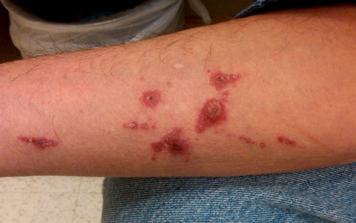 A 34-year-old forest service firefighter comes to the physician with an itchy rash on both arms.  The rash began as small red papules 3 days ago and subsequently developed yellow blisters.  The lesions appear to be spreading to the adjacent skin.  He has no fever, chills, or malaise.  The patient has no significant past medical history and takes no medications.  He has been sexually active with a new partner over the last 6 months and uses condoms.  He rents an apartment with 2 friends and they share a bathroom. A photograph of his arm is shown below.   Which of the following is the best initial treatment for this patient's condition? A) Antifungal therapy B) Antiviral therapy C) Corticosteroid D) Penicillin antibiotic E) Permethrin