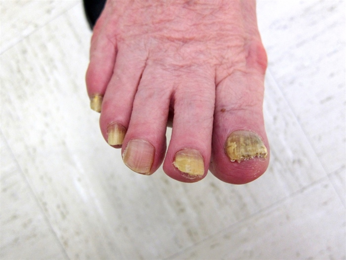 A 63-year-old woman reports changes in her toenails.  The toenails of her right foot have been discolored for 3 years and are becoming thicker and more difficult to cut.  She experiences pain in her toenails when wearing some of her high-heeled shoes.  The patient feels that her toenails are  embarrassing  when she is barefoot at the beach. A photograph of her foot is shown below.   A KOH preparation of material removed from under the nails reveals hyphae. What is the best therapy for this patient? A) Daily griseofulvin B) Daily terbinafine C) Once-weekly fluconazole D) Pulse itraconazole E) Topical ciclopirox