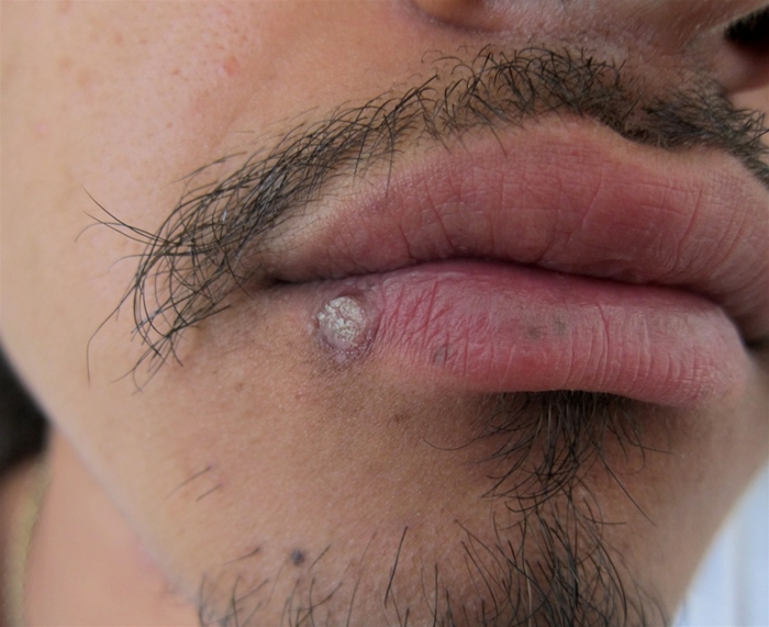 A 23-year-old-man comes to the clinic seeking treatment for a facial lesion.  He has had similar lesions that resolved spontaneously.  He has no associated pain, itching, or burning.  The patient works as a meat packer.  He would like the lesion removed as he has started dating and thinks that the  bump  on his face would hinder this process.  He has no previous medical problems and takes no medications. The lesion is shown in the photograph below:   What is the best treatment option for this patient? A) Antifungal cream B) Salicylic acid C) Snip or shave excision D) Topical corticosteroid E) Oral acyclovir