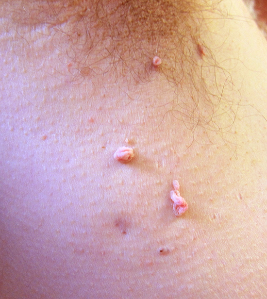 A 47-year-old man comes to the physician concerned about growths in his axilla.  He has noticed these for a few years but thinks that they are growing larger and becoming uncomfortable.  Recently, the growths have bled when disturbed.  He has no other medical problems or concerns.  Skin examination findings are shown in the image below.   There is no axillary adenopathy.  The remainder of the examination is normal. This patient's condition is most likely associated with which of the following? A) Diabetes mellitus B) Gastrointestinal malignancy C) Gluten-sensitive enteropathy D) HIV infection E) Neurofibromatosis