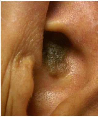 A 60-year-old man comes to the physician with a growth in his left ear.  It has been present for a while and never bothered him, but his wife insisted that it be  checked out.   His past medical history is significant for hypertension treated with amlodipine and losartan.  He has no family history of cancer.  He had a colonoscopy 2 years ago and 2 small adenomatous polyps were excised.  The skin examination findings are shown in the photograph below.   Which of the following is the most likely diagnosis? A) Actinic keratosis B) Basal cell carcinoma C) Lentigo maligna D) Neurofibroma E) Seborrheic keratosis