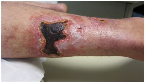A 62-year-old man complains of a black lesion and severe pain in his left leg.  Initially the lesion was red, but over the past 3 days it has become black.  He has end-stage renal disease due to diabetic nephropathy and has been on hemodialysis for the last 10 years.  The patient's past medical history is also significant for hypertension, gout, and previous episodes of deep venous thrombosis requiring lifelong anticoagulation with warfarin. His vitals signs are within normal limits.  The leg lesion is shown in the picture below.   The lesion is exquisitely tender, but the area is not warm to palpation.  Femoral and other peripheral pulses are 2+ bilaterally.  There is no lymphadenopathy and no other skin lesions are noted.  The remainder of the physical examination is within normal limits. Laboratory results are as follows:   Which of the following is the most likely diagnosis? A) Calciphylaxis B) Cholesterol atheroembolism C) Necrobiosis lipoidica D) Pyoderma gangrenosum E) Warfarin-induced skin necrosis