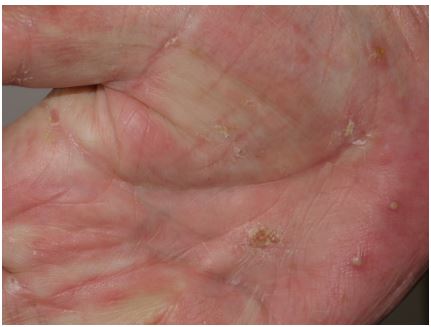 A 25-year-old man comes to the physician with intense itching of his hands and wrists that prevents him from sleeping.  The itching started about 1 week after he returned from a month-long stay in Europe.  He had sexual contact with 2 paid sex workers while there.  His itching involves predominantly the webs of his fingers and the flexor surfaces of his wrists.  He has no other medical problems and takes no medications. Vital signs are within normal limits.  Examination of the skin shows the following:   Rapid HIV and syphilis testing return negative. What would be the most effective treatment for his current condition? A) Intralesional injection of corticosteroids B) Oral acyclovir C) Oral antihistamine D) Topical ketoconazole E) Topical permethrin