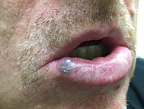 A 70-year-old retired farmer seeks evaluation for 2  lumps  on his skin.  One is on his lower lip and the other is on his ear.  These have been present for  a while  and seem to be getting larger.  He recently saw a television show on skin cancer and thought he should get these checked.  He has no other health concerns. His vital signs are normal.  The lip lesion is shown in the photograph below.  The lesion reduces in size when compressed.   What is the most likely diagnosis? A) Basal cell carcinoma B) Blue nevus C) Nodular melanoma D) Squamous cell cancer E) Venous lake
