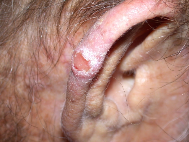 A 75-year-old man comes to the physician for a sore on his ear that he says  won't heal.   He is a retired lineman for an electrical company in a rural area.  He first noticed a small lump on the top of his ear 1 year ago.  It has grown and opened up into a painful sore that has not responded to a topical antibiotic cream. He has a history of hypertension, chronic gouty arthritis, hyperlipidemia, and chronic kidney disease with a stable serum creatinine of 2.0 mg/dL.  His current medications include atenolol, fosinopril, allopurinol, and simvastatin. His vital signs are stable.  The lesion on his right pinna is shown in the photograph below.   What is the most likely diagnosis for this patient's nonhealing ulcer? A) Actinic keratosis B) Calciphylaxis C) Gouty tophus D) Pyogenic granuloma E) Squamous cell carcinoma
