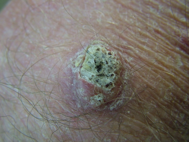 A 60-year-old man comes to the physician because of concerns about a lesion on his leg.  It first appeared 3 months ago and rapidly grew to its current size.  For the past several weeks, it has been stable with no additional growth.  There is no associated pain. The lesion is shown in the photograph below.   What is the most likely diagnosis? A) Basal cell cancer B) Keratoacanthoma C) Molluscum contagiosum D) Prurigo nodule E) Pyogenic granuloma