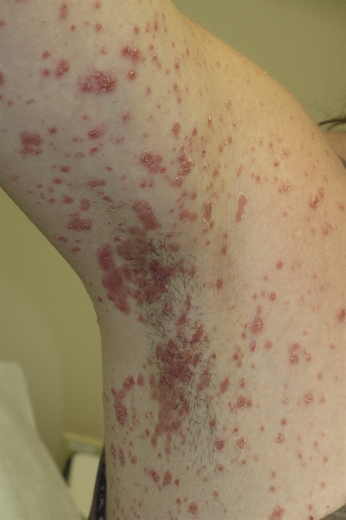 A 22-year-old-woman comes to the office with a rash that started 2 days earlier with the sudden appearance of multiple red spots on the trunk and arms.  The rash is mildly pruritic but not painful.  She has used no new medications or over-the-counter hygiene products.  The patient had a sore throat that started 2 weeks ago and is slowly getting better.  She has no other medical problems and takes no prescription medications.  She drinks 2 or 3 beers on the weekend but does not use tobacco or illicit drugs. On physical examination, the patient appears well.  Vital signs are normal.  The throat has erythema but no exudate.  No cervical lymphadenopathy is noted.  Cardiopulmonary examination is normal.  The rash is shown in the photograph below.  The palms and soles are spared.   Which of the following is the most likely diagnosis? A) Discoid lupus B) Erythema nodosum C) Guttate psoriasis D) Nummular eczema E) Secondary syphilis