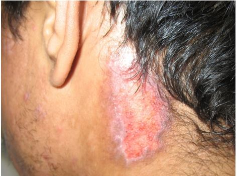 A 34-year-old man comes to the physician with lesions on his face, scalp, and neck.  He has had the lesions for 1 year and they are slowly growing in size and number.  There is mild pruritus that worsens with exposure to sunlight.  The patient has no fever, arthralgias, or myalgias.  He has no other medical problems and takes no medications. The neck lesion is shown in the photograph below.   Lesions on the face and scalp have a similar appearance.  The scalp lesion has hair loss. Which of the following is the most likely diagnosis? A) Discoid lupus B) Lichen planus C) Psoriasis D) Subacute cutaneous lupus E) Vitiligo