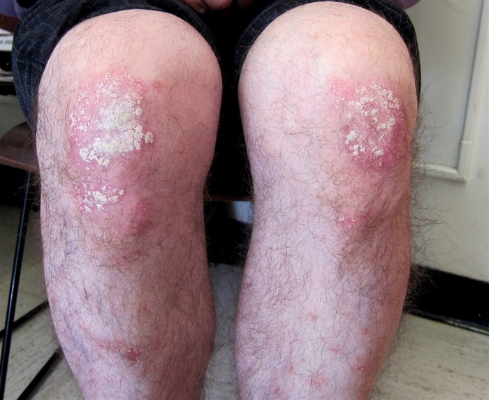 A 40-year-old man comes to the physician for evaluation of a rash involving his knees and shins.  The rash has been present for 9 months with mild itching that worsens in winter.  No other areas of the patient's body are involved, and he has no musculoskeletal symptoms.  His general health is good and he takes no medications. A general physical examination is within normal limits.  Nail examination is normal.  His knees are shown in the photograph below.   What would be the most appropriate initial therapy for this patient? A) Etanercept B) Methotrexate C) Phototherapy D) Topical corticosteroids and calcipotriene E) Topical tacrolimus