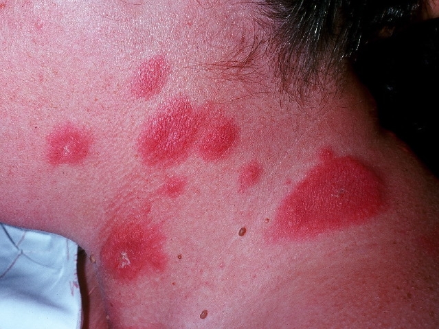 A 42-year-old man comes to the physician with painful skin lesions.  The lesions developed on his neck, chest, and arms 1 week ago.  He also complains of fever, headache, malaise, and arthralgias.  Three weeks ago, he had an upper respiratory infection that resolved with over-the-counter medications.  The patient has no other medical problems and takes no medications.  He does not use tobacco or illicit drugs and drinks alcohol on social occasions.  He works as a cab driver. His temperature is 38.2° C (100.8° F) , blood pressure is 120/70 mm Hg, pulse is 88/min, and respirations are 14/min.  Physical examination is otherwise unremarkable. Skin findings are shown in the photograph.   Laboratory studies show a leukocyte count of 14,000 cells/µL with 87% neutrophils.  He is started on oral clindamycin and sent home. The patient returns for follow-up 3 days later with no improvement.  Blood cultures obtained on the initial visit show no growth.  Biopsy of the lesion shows a dense neutrophilic infiltrate in the dermis without vasculitis.  Gram and fungal stains are negative. Which of the following is the most appropriate next step in management? A) Add corticosteroids and stop clindamycin B) Change clindamycin to vancomycin C) Check anti-dsDNA antibodies D) Echocardiogram E) Hepatitis C antibody testing