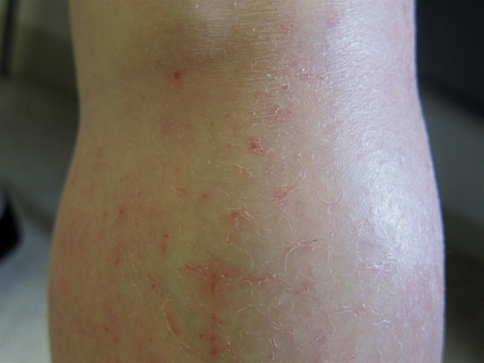 A 65-year-old woman comes to the physician with a pruritic rash.  This is the second year the rash has appeared, both times during the onset of winter.  She has intensely pruritic areas on her lower extremities along the shins and above the right lateral malleolus.  The patient sometimes experiences pruritus on her lower back and the extensor surfaces of the forearms.  One area usually predominates.  There is no visible rash initially, but the involved areas can become rough and scaly after a few weeks of frequent scratching.  Her only other medical problem is perennial rhinitis.  Her medications include cetirizine, calcium plus vitamin D supplements, and a multivitamin. Skin examination findings are shown in the photograph.   Which of the following is the best next step in management of this patient? A) Capsaicin ointment B) Comprehensive metabolic panel  and thyroid-stimulating hormone C) Moisturizing agent D) Skin biopsy E) Topical terbinafine