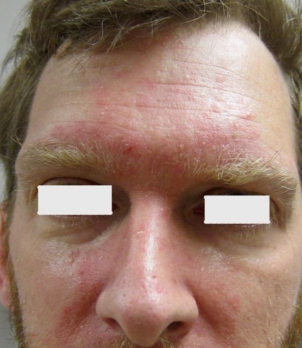 A 47-year-old man comes to the physician with a scaly rash on his face.  Two weeks ago, he went to an urgent care clinic and was treated with a topical corticosteroid and antifungal agent.  Despite consistent use of these agents, the rash has not improved.  He also has new areas on his arms and legs.  He reports that he feels constantly embarrassed by his condition. The skin examination findings are shown in the photograph below.   Which of the following is the best next step in management of this patient? A) Antinuclear antibody testing B) HIV testing C) Metronidazole gel D) Syphilis testing E) Topical vitamin D analog