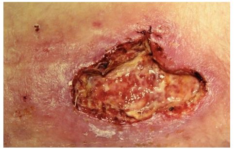 A 42-year-old man complains of skin lesions on his legs for the last 6 weeks.  He has become concerned because they are enlarging rapidly, are painful, and have started to drain pus.  He has not had similar symptoms before.  The patient has no trauma to the area, fevers, or night sweats.  He takes analgesics for chronic low back pain and is on a lactose-free diet due to diarrhea.  The patient tries to be compliant with his diet but still has crampy abdominal pain and frequent bowel movements, occasionally at night.  He does not use intravenous drugs. His vital signs are normal.  Skin examination is shown in the photograph.   Laboratory analysis shows an elevated C-reactive protein and erythrocyte sedimentation rate.  X-ray of both legs reveals no bony erosions or soft-tissue gas. Which of the following is the most likely diagnosis? A) Erythema nodosum B) Leukocytoclastic vasculitis C) Mycobacterial infection D) Necrobiosis lipoidica E) Pyoderma gangrenosum