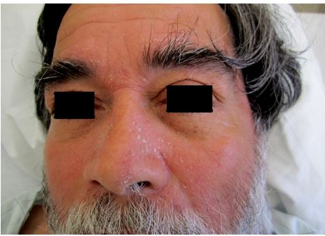 A 65-year-old man comes to the clinic with 1 week of pruritic facial rash.  He was recently diagnosed with community-acquired pneumonia and is on day 8 of his 10-day antibiotic course.  He otherwise feels healthy and has no other complaints. His past medical history includes Parkinson disease, mild dementia, and hypertension.  His medications include carbidopa-levodopa, donepezil, amlodipine, and levofloxacin. The rash is shown in the image below.   Which of the following is the best next step in management of this patient's facial rash? A) Discontinuation of oral antibiotic B) High-potency steroid ointment C) Low-potency steroid cream and antifungal cream D) Skin biopsy E) Triple antibiotic ointment