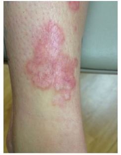 A 45-year-old woman comes to the physician with  reddish spots  on her legs.  She first noticed them 3 months ago and says that they are slowly spreading.  Her medical problems include type 2 diabetes mellitus, acid reflux disease, hypertension, chronic constipation, and hypothyroidism.  Her medications include metformin, levothyroxine, lisinopril, omeprazole, and as-needed senna. Her temperature is 37.2 C (99 F) , blood pressure is 120/80 mm Hg, pulse is 78/min, and respirations are 12/min.  Her body mass index is 27 kg/m<sup>2</sup>.  Several spots are seen in the pretibial region of each leg, as shown in the image below.  The examination also shows clear lung fields, normal first and second heart sounds, and a 1/6 systolic murmur at the apex.   Which of the following is the most likely diagnosis? A) Discoid lupus B) Drug eruption C) Necrobiosis lipoidica D) Pretibial myxedema E) Sarcoidosis