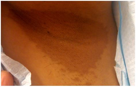 A 45-year-old obese woman with diet-controlled diabetes mellitus comes to the physician with mild pruritus in both axillary areas.  Physical examination findings are shown in the image below.   Examination with Wood's lamp shows red fluorescence in the affected areas.  Which of the following is the most likely diagnosis? A) Candida infection B) Erythrasma C) Inverse psoriasis D) Microsporum infection E) Seborrheic dermatitis