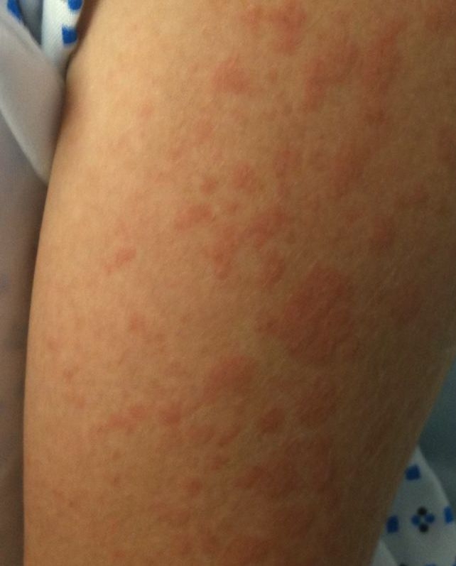 A 55-year-old woman comes to the physician with a 6-month history of a diffuse rash.  The patient has episodes of localized itching on her arms followed by a rash that worsens over a few hours before spontaneously resolving.  The rash has also occurred on her arms, legs, and back.  The most recent episode occurred 2 days ago, and the patient has brought a photograph of the rash, shown below.  She has no trauma, insect bites, travel history, or sick contacts.  The patient has a history of hypertension, diabetes, and osteoarthritis of her knees.  Her medications include metformin, lisinopril, and occasional ibuprofen.  She does not use tobacco, alcohol, or illicit drugs. The patient's temperature is 36.1 C (97 F) , blood pressure is 138/77 mm Hg, and pulse is 78/min.  Her physical examination is within normal limits.   Which of the following is the next best step in management of this patient? A) Hydroxyzine B) Loratadine C) Montelukast D) Prednisone E) Ranitidine