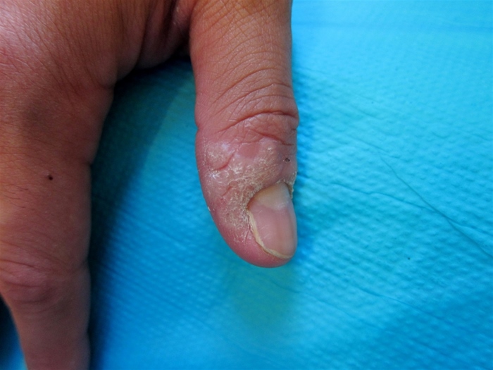 A 30-year-old man comes to the physician for evaluation of a rash on his right thumb.  He initially noticed a small lesion near the nail margin that has progressively worsened over the past 2-3 weeks.  He has no other medical conditions and no history of tobacco or alcohol use.  He works in the kitchen of a local restaurant.  The patient has been sexually active with a single partner in the past year. His temperature is 36.1 C (97 F) , blood pressure is 128/76 mm Hg, and pulse is 78/min.  Skin examination findings are shown below.  The remainder of the physical examination is within normal limits.   Which of the following is the next best step in management of this patient? A) Curettage and desiccation B) Imiquimod C) Liquid nitrogen D) Salicylic acid E) Shave excision
