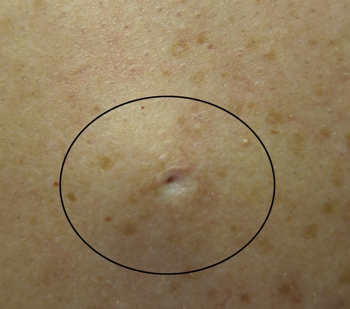 A 32-year-old man comes for evaluation of a bump on the right side of his chest.  He initially noticed it 4 months ago, and it has grown slightly larger in the past month.  The patient has not experienced any trauma to the area or recent surgeries.  He does not use tobacco or alcohol. Skin examination is shown below.  There is no drainage from the lesion or tenderness to palpation.  The lesion does not change in shape when pinched at the edges.  The remainder of his physical examination is within normal limits.   Which of the following is the most likely diagnosis? A) Acne vulgaris B) Dermatofibroma C) Epidermal inclusion cyst D) Lipoma E) Pyogenic granuloma