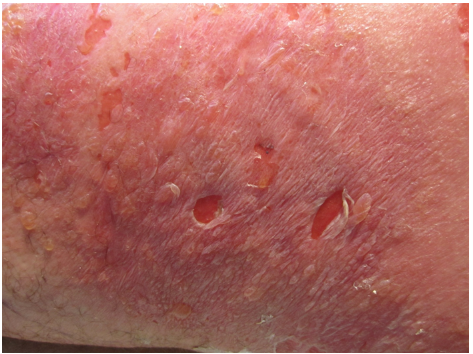 A 45-year-old man comes to the physician for evaluation of a rash on his right leg.  He initially developed a minor traumatic laceration 3 weeks ago.  He applied hydrogen peroxide and an over-the-counter topical antibiotic cream (neomycin-polymyxin-bacitracin) .  The laceration improved during the first 4 days, but then a rash with significant pruritus and clear drainage developed around the wound over the next 2 weeks.  The patient has a history of diabetes, hypertension, and hypercholesterolemia.  His current medications include metformin, lisinopril, and rosuvastatin.  He has no history of tobacco or alcohol use. His vital signs are within normal limits.  Skin examination of the right leg is shown below.  There is clear drainage from the lesions and warmth to palpation.  There is no tenderness.  Examination of the extremities shows no pedal or ankle edema.  The remainder of his physical examination is normal.   Which of the following is the most likely diagnosis? A) Contact dermatitis B) Erysipelas C) Necrotizing fasciitis D) Stevens-Johnson syndrome E) Toxic shock syndrome