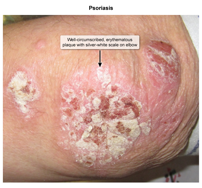 A 57-year-old man comes to the physician for evaluation of a rash on his elbows and knees.  He initially had the rash 3 years ago, and it reoccurs every 3-4 months in the same regions.  The patient has no pruritus or discharge during the episodes but notices an occasional silvery scale. Vital signs are within normal limits.  Skin examination of the left elbow is shown below.  There is no drainage from the lesions or tenderness to palpation.   Which of the following is the best next step in management of this patient? A) Biologic immunomodulator B) High potency topical steroid C) Low potency topical steroid D) Oral prednisone E) Topical calcineurin inhibitor