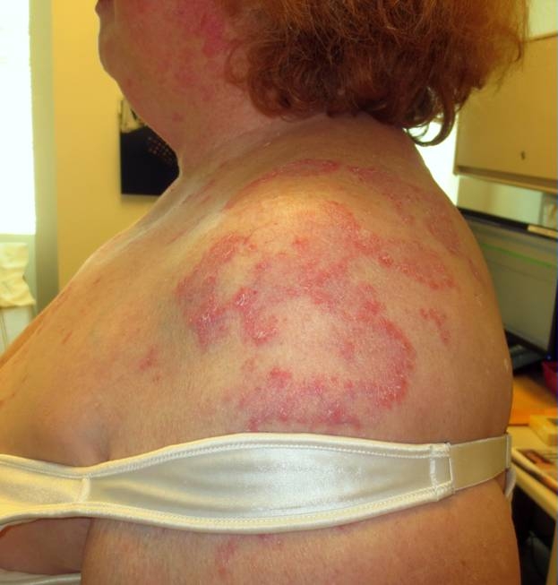 A 49-year-old woman comes to the physician for evaluation of a rash on her back and shoulders.  She initially noticed the rash nearly 2 years ago.  The rash began as a red scaly area that progressed from the shoulders to the neck region and upper back.  There was no pruritus, and the rash spontaneously resolved after a few days.  The patient has had a recurrence of the rash every 2-3 months since that time. Skin examination (Image shown below)  shows erythematous and scaly papules with crusted margins.  There is no drainage from the lesions or tenderness to palpation.  The remainder of her physical examination is normal.   Which of the following is the most likely diagnosis? A) Nummular eczema B) Plaque psoriasis C) Seborrheic dermatitis D) Subacute cutaneous lupus erythematosus E) Tinea corporis