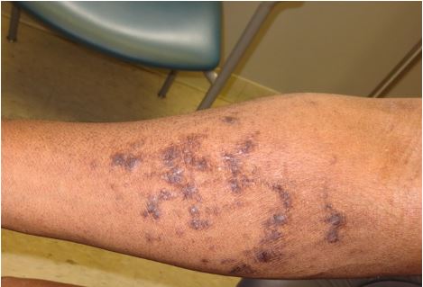 A 50-year-old man comes to the physician for evaluation of an itchy rash on his extremities for the last several weeks.  He was diagnosed with hepatitis C infection 6 months ago but refused further workup and treatment.  His vital signs are normal.  Skin findings are shown in the image below.  The remainder of the examination is within normal limits.   Which of the following is the most appropriate treatment for this patient's current condition? A) Emollients only B) Oral lamivudine C) Topical antifungal therapy D) Topical corticosteroids E) Topical vitamin D