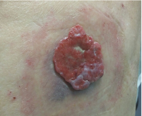 An 87-year-old woman is brought to the office for a lesion on her back.  She lives by herself and is very reluctant to seek medical care.  Her daughter, who is visiting from out of state, found a foul-smelling discharge coming from the lesion.  The lesion has gradually enlarged over the past 3-4 years, and the patient has cleaned it with over-the-counter antiseptics.  She has a history of sunburn in the area many years ago.  She has no pain or fever.  The patient has no other medical conditions.  She does not use tobacco or alcohol. The lesion is shown in the image below.  She has no other masses or lymphadenopathy.   Which of the following is the most likely diagnosis? A) Inflamed seborrheic keratosis B) Malignant melanoma C) Necrotic skin wart D) Pyogenic granuloma E) Squamous cell cancer