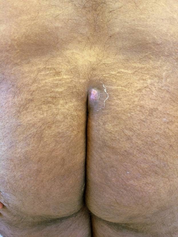 A 35-year-old man comes to the urgent care center with 2 days of pain in the intergluteal area made worse with sitting.  For the last several years, he has had staining of the underwear in that area with clear fluid.  The patient has no other symptoms or medical conditions.  His temperature is 37 C (98.6 F) .  Physical examination shows mild swelling and tenderness at the midline immediately below the coccyx with a small sinus opening.   Which of the following is the most likely diagnosis? A) Condylomata acuminata B) Crohn disease C) Hidradenitis suppurativa D) Perianal abscess E) Pilonidal disease