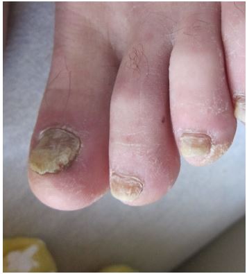 A 42-year-old woman comes to the office due to worsening toenail disfiguration over the past 3 months.  The patient has had no lower extremity pain or redness and recalls no trauma.  She has a history of hypertension and takes hydrochlorothiazide. Examination findings are shown in the image.   Which of the following is the best next step in management of this patient? A) Biopsy from the nail bed B) Potassium hydroxide (KOH)  preparation of nail scrapings C) Topical antibiotic and antiseptic soaks D) Topical antifungal therapy E) Topical corticosteroid therapy