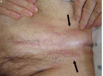 A 45-year-old man comes to the office for evaluation of a rash on his abdomen.  The rash started 3 weeks ago and has slowly worsened since.  There is no pruritus.  The patient has a history of diabetes treated with metformin.  He has no history of tobacco or alcohol use. Vital signs are within normal limits.  BMI is 32 kg/m<sup>2</sup>.  Skin examination findings are shown in the image below.  There is no warmth or tenderness around the skin lesions.  The remainder of his physical examination is normal.   Which of the following is the best next step in management of this patient? A) Oral cephalexin B) Oral fluconazole C) Topical hydrocortisone ointment D) Topical miconazole E) Topical tacrolimus