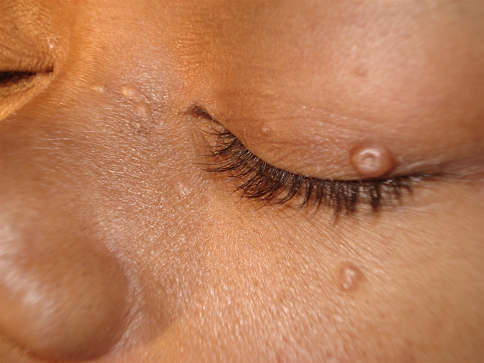 A 35-year-old woman comes to the office for evaluation of a rash on her face.  The rash started 3 weeks ago and has slowly worsened.  There is no pruritus.  The patient has no significant past medical history and no history of tobacco or alcohol use. Vital signs are within normal limits.  Her BMI is 27 kg/m<sup>2</sup>.  Skin examination findings are shown in the image below.  There is no warmth or tenderness around the skin lesions.  The remainder of her physical examination is normal.   Which of the following is the best next step in management of this patient? A) Histoplasma antigen testing B) HIV testing C) Serum cryptococcal antigen D) Serum rapid plasma reagin E) Varicella titers