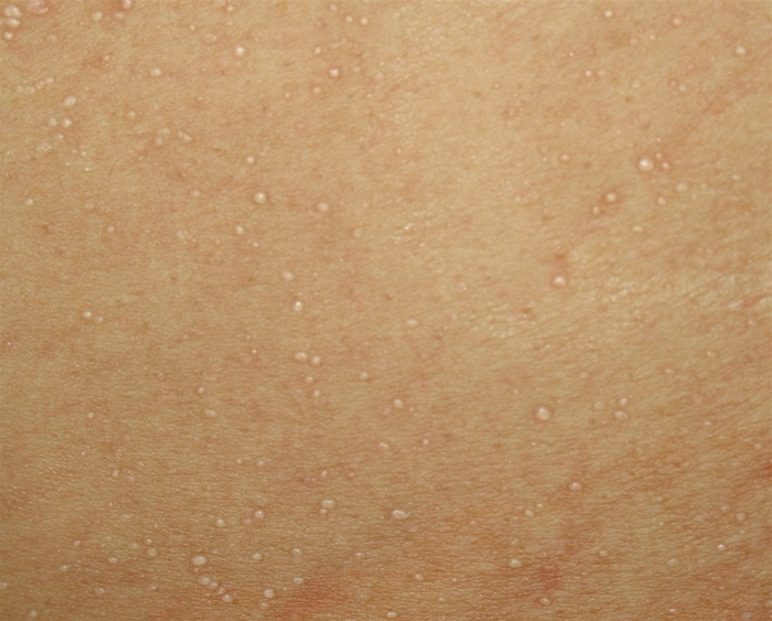 A 75-year-old woman comes to the office for evaluation of a rash on her chest.  She is nonambulatory and lives in a nursing home.  One week ago, the patient had a fever with a productive cough of yellow sputum.  She was started on azithromycin for presumed pneumonia with slight improvement in her symptoms.  However, her caregivers have noted significant sweating over the past 5 days and a diffuse rash on her chest, abdomen, and back.  She has a history of hypertension, stroke, and dementia. Her vital signs are within normal limits.  Skin examination is shown in the image below.  There is no warmth or tenderness around the skin lesions.   Which of the following is the most likely diagnosis? A) Folliculitis B) Herpes zoster C) Keratosis pilaris D) Miliaria E) Urticaria