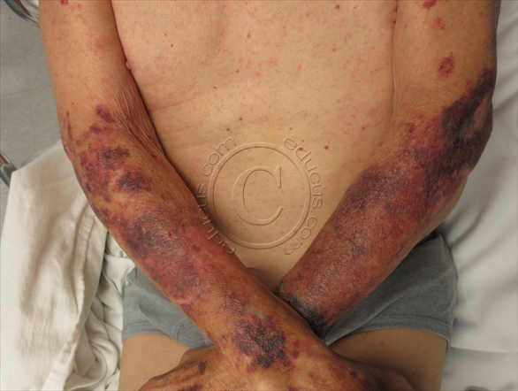 An 82-year-old farmer comes to the office due to easy bruising.  Over the past year, he has had intermittent bruising on his arms with minimal trauma.  The patient has had no bloody or dark-colored stools or other symptoms.  He has a history of hypertension and osteoarthritis and had a left total hip replacement several years ago with no postoperative issues.  The patient used to drink heavily but has been sober for more than 10 years.  He has no family history of bleeding disorders.  Vital signs are within normal limits.  Physical examination shows no mucosal lesions.  Cardiopulmonary auscultation is normal.  The abdomen is soft and nontender.  Skin findings are as follows:   The lesions are not raised or tender, and the remainder of the skin examination is normal.  Laboratory results are as follows:   Which of the following most likely predisposed this patient to this skin condition? A) Alcoholic liver injury B) Antibiotic use C) Chronic hepatitis C D) Decreased vitamin C intake E) Extensive sun exposure