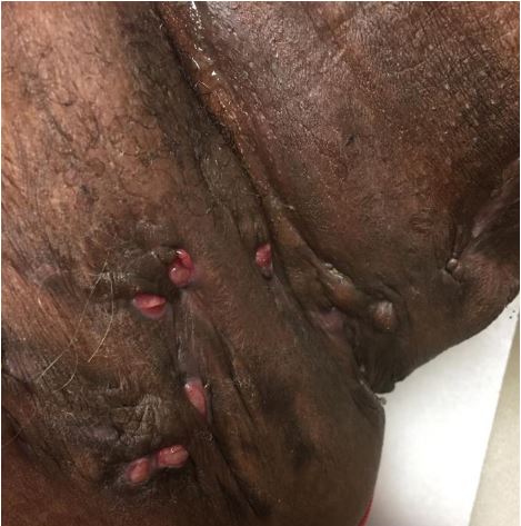 A 48-year-old man comes to the office due to recurrent  painful lumps  in both axillae that often rupture spontaneously.  He has had these lesions for the past several years, but lately they are recurring more frequently.  The discharge from the lesions has an unpleasant smell, and the patient has to use deodorant several times daily.  He also takes an over-the-counter nonsteroidal anti-inflammatory drug for pain.  The patient has had no fever, chills, cough, anorexia, or weight loss.  He has no other medical problems.  The patient has not traveled out of his home state of Ohio for the past several years and works as a landscaper in a park.  He smokes a pack of cigarettes daily but does not use alcohol or illicit drugs. Vital signs are within normal limits.  BMI is 47 kg/m<sup>2</sup>.  The axillary areas have findings as shown below, and the remainder of the physical examination shows no abnormalities.   Which of the following is the most likely diagnosis in this patient? A) Cutaneous blastomycosis B) Hidradenitis suppurativa C) Irritant contact dermatitis D) Recurrent folliculitis E) Tuberculous lymphadenitis