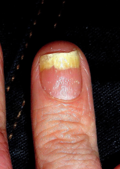A 50-year-old woman comes to the office due to nail discoloration for the past several months.  The patient is a realtor and says she feels embarrassed to shake hands with clients due to nail disfiguration.  She has used several over-the-counter antifungal creams but with no relief.  The patient reports no fever, chills, joint pain, or skin rash.  She has no prior medical problems and takes only a daily multivitamin supplement.  The patient has smoked half a pack of cigarettes daily for 30 years and drinks alcohol occasionally. Vital signs are within normal limits.  Most of her fingernails have the findings shown in the image below.   Which of the following is the most appropriate next step in management of this patient's condition? A) Chest radiography B) Microscopy of nail scraping C) Thyroid function studies D) Viral hepatitis serology E) Whole-body skin examination