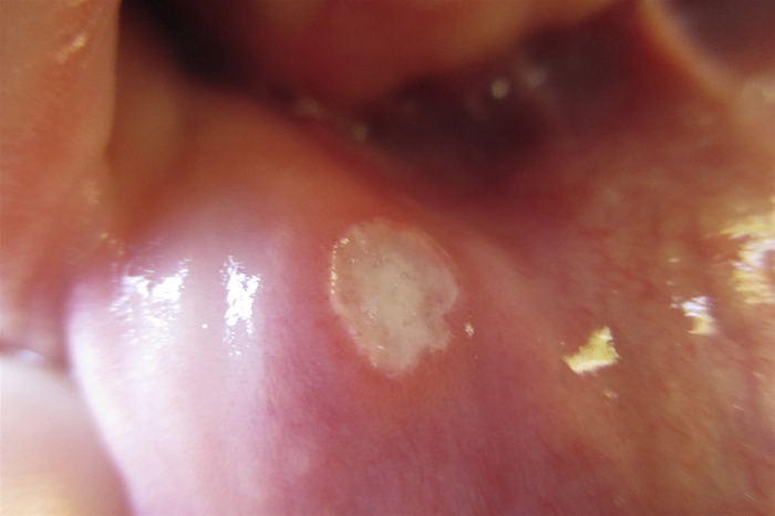A 24-year-old woman comes to the office due to a painful lesion in her mouth.  She has had similar lesions once or twice a year over the last several years that caused significant discomfort with chewing and lasted 6-7 days.  She has no associated rashes, joint pains or swelling, or genital lesions.  She does not have any significant past medical history and does not use tobacco or alcohol.  The patient is HIV-negative.  Her mother has rheumatoid arthritis.  Physical examination findings are shown in the image below.   Complete blood count and comprehensive metabolic panel are within normal limits.  Erythrocyte sedimentation rate is 12 mm/hr. Which of the following is the best next step in management of this patient? A) Anti-cyclic citrullinated peptide antibodies B) Antinuclear antibodies C) Colonoscopy D) Thyroid function tests E) Topical treatment