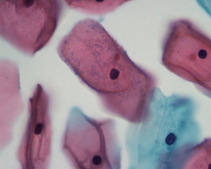 An 18-year-old woman comes to the office for evaluation of vaginal discharge that is thin, gray, and malodorous.  The patient has had no vulvovaginal pruritus or pelvic pain.  She is sexually active with multiple partners and uses oral contraceptives but does not consistently use condoms.  Her general health is good.  She recently completed a course of antibiotics for uncomplicated cystitis.  Review of systems is negative. Vital signs are normal.  Speculum examination reveals a gray, adherent, malodorous discharge on the walls of the vaginal vault.  The cervix appears normal and there is no cervical motion tenderness. Vaginal pH is 5.  Microscopic examination is shown below:   Which of the following is the best therapy for this patient? A) Ceftriaxone B) Doxycycline C) Fluconazole D) Metronidazole E) Trimethoprim-sulfamethoxazole