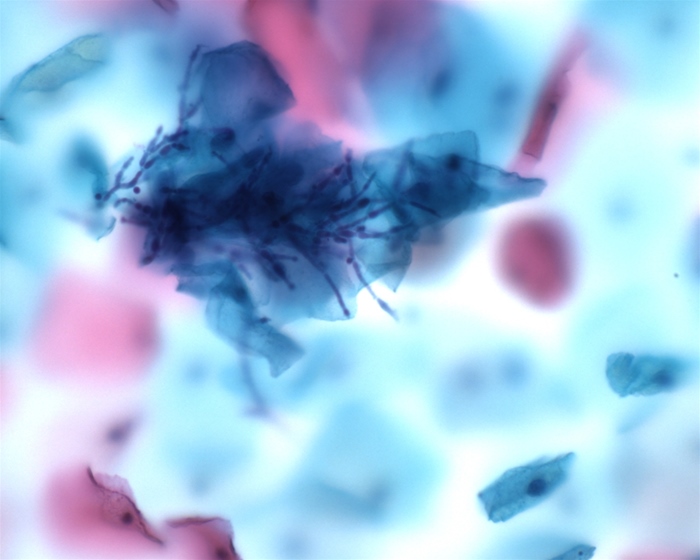 A 42-year-old woman comes to the office for an annual examination.  The patient feels well and has regular menses with no abnormal bleeding.  She has a new vaginal discharge but no vulvar pruritus or pelvic pain.  The patient is sexually active and has had only women partners.  Her current relationship began 6 months ago.  She has no chronic medical conditions and takes no medications. Vital signs are normal.  BMI is 31 kg/m<sup>2</sup>.  There is no vulvar erythema.  Microscopic examination of the vaginal discharge reveals the following:   Which of the following is the most likely diagnosis in this patient? A) Bacterial vaginosis B) Mycoplasma cervicitis C) Neisseria gonorrhoeae cervicitis D) Trichomonas vaginitis E) Vaginal candidiasis