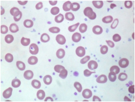 A 56-year-old man from Southeast Asia comes to the physician because of fatigue, low grade fever, and left upper abdominal discomfort for the past 1 month.  He denies bleeding, recent infections, or previous hospitalizations.  His other medical problems include hypertension, for which he is taking hydrochlorothiazide and atenolol. Vital signs are within normal limits.  Examination shows massive splenomegaly and moderate hepatomegaly.  There is no lymphadenopathy.  Cardiopulmonary examination is normal.  The remainder of the examination is within normal limits. Laboratory results are as follows:   Peripheral blood smear is shown below:   Which of the following is the most likely diagnosis? A) Chronic myeloid leukemia B) Malaria C) Myelodysplastic syndrome D) Primary myelofibrosis E) Thalassemia intermedia