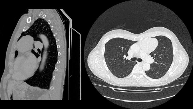 A 54-year-old man with no significant past medical history comes to the physician with complaints of fatigue over the last 2 months.  He tried to exercise a few times but tired easily.  The patient is so exhausted by the end of the day that he starts  to see double.   An upper respiratory illness 2 weeks ago left him extremely fatigued.  He has also noticed occasional trouble swallowing and frequent coughing while drinking.  The patient has no fever, cough, chills, weight loss, or night sweats.  He does not use tobacco, alcohol, or illicit drugs.  He has been married for 26 years and has no HIV risk factors. His blood pressure is 122/68 mm Hg, and pulse is 82/min.  His BMI is 25 kg/m<sup>2</sup>.  There is no scleral icterus or conjunctival pallor on inspection.  Visual field examination is within normal limits.  No enlarged lymph nodes are palpated.  Lungs are clear to auscultation.  There is no palpable spleen tip. After initial evaluation, CT scan of the chest is performed (see below) .   Which of the following is the most likely diagnosis? A) Large B-cell lymphoma B) Secondary tuberculosis C) Small cell lung cancer D) Substernal goiter E) Thymoma