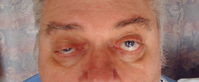 A 54-year-old man comes to the office due to seeing double while watching TV at night.  The sensation resolves when he closes either eye.  The patient gets a mild headache when he experiences double vision but has no associated nausea, vomiting, photophobia, or phonophobia.  According to his wife, his voice gets a little  nasal  in the evening.  He has no other medical problems and does not use tobacco, alcohol, or illicit drugs. The patient's vital signs are normal.  His eyes are shown in the image below.  Eye movements are full, and pupils are equal and equally reactive to light with a brisk response.  Funduscopic examination is normal.  There is no extremity weakness or sensory loss.  He is stable in the Romberg position.  The remainder of the physical examination is normal.   Which of the following is the best next step in management of this patient? A) Autoantibody testing B) CT scan of the chest C) Edrophonium test D) Prednisone therapy E) Pyridostigmine therapy
