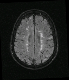 A 38-year-old woman comes to the physician with left facial numbness and paresthesias for the last 3 days.  She is a known intravenous drug user.  One month ago, she had an episode of blurry vision in her right eye and vertigo that resolved spontaneously.  One year ago, she was admitted to the hospital with fever to rule out endocarditis.  Transesophageal echocardiography at that time showed no vegetations but did demonstrate a small secundum-type atrial septal defect.  The patient's past medical history is also significant for hypothyroidism, migraine disorder, and hypertension. Her temperature is 37.2 C (99 F) , blood pressure is 140/88 mm Hg, and pulse is 85/min.  Her body mass index is 28 kg/m<sup>2</sup>.  The patient is awake and in mild distress.  Examination shows a pale right optic disc, right relative afferent pupillary defect, and reduced sensation on the left side of the face.  Motor examination shows a slight pronator drift in the right upper extremity with increased tone and hyperreflexia.  She also has mild dysmetria in the left upper extremity. MRI of the brain with and without gadolinium is performed; the T2/FLAIR sequence is shown in the image below.   Which of the following would be most helpful in confirming the diagnosis in this patient? A) Brain biopsy B) HIV testing C) Lumbar puncture D) MR angiography of the brain E) Transesophageal echocardiogram