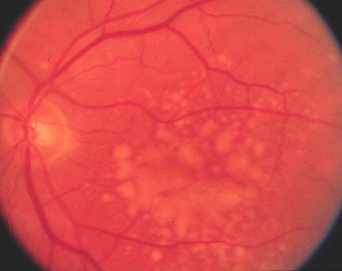 A 67-year-old man comes to the office due to decreased vision in his left eye.  While driving 2 weeks ago, he noticed things appeared distorted or were  missing.   He has also had difficulty reading despite changing his reading glasses multiple times over the last several months.  The patient has had no headaches, eye pain, or double vision.  He has a long-standing history of hypertension and is an ex-smoker with a 40-pack-year history. Funduscopic findings are shown in the image below.   Which of the following is the most likely diagnosis? A) Age-related macular degeneration B) Central retinal artery occlusion C) Hypertensive retinopathy D) Open-angle glaucoma E) Retinal detachment